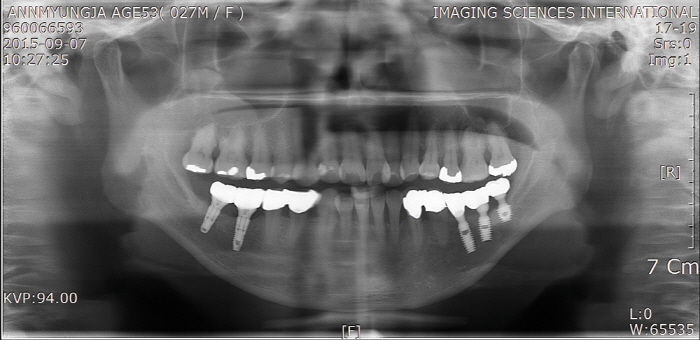 ׸ 7. 2015 8  ö   Panorama x-ray