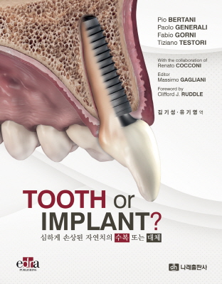 Tooth or Implant? - ϰ ջ ڿġ  Ǵ ü